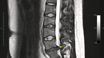 Hérnia de Disco - Quando me Preocupar? Sintomas, Tratamentos 15 hernia disco 7