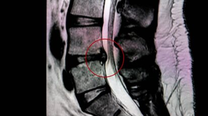 Hérnia de Disco Extrusa: A Cirurgia é Realmente a Única Saída? 4 hernia de disco extrusa