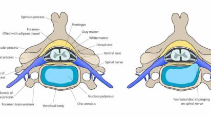Protrusão Discal: Entenda a Gravidade e as Opções de Tratamento Sem Cirurgia 1 protrusao discal