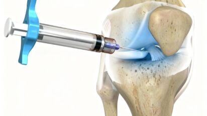 viscosuplementacao infiltracao acido hialuronico